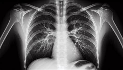Radiografia toracica con iperafflusso polmonare