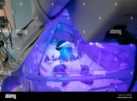 Neonato sottoposto a fototerapia per l'ittero
