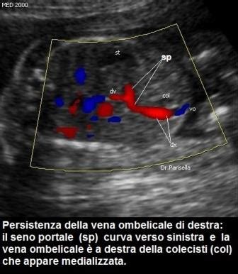 varianti persistenza vena ombelicale destra