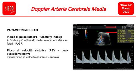 doppler arteria cerebrale media