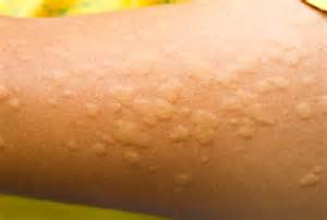 Primo piano di pomfi di orticaria su una gamba di bambino