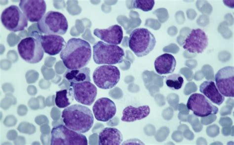 Cellule tumorali al microscopio