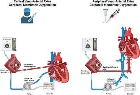 Schema della procedura Exit to Ecmo