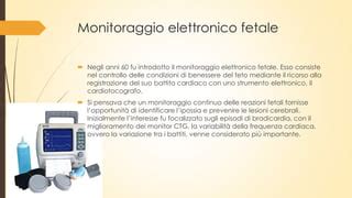 Illustrazione del monitoraggio CTG durante il travaglio