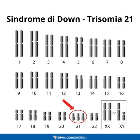 Diagramma dei cromosomi nella Sindrome di Down