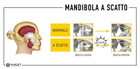 diagramma che illustra la corretta posizione della mandibola con il bite