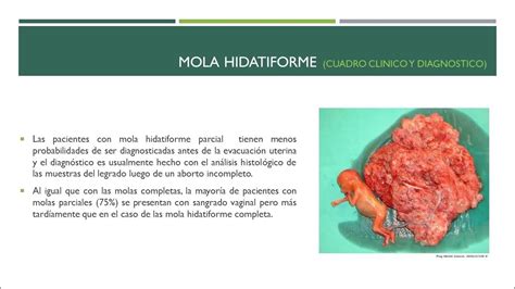 Mola idatiforme: aspetto istopatologico (completo)