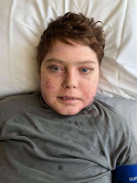 Bambina con epidermolisi bollosa (Bambino Farfalla)