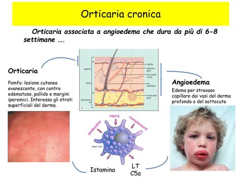 Schema di un pomfo di orticaria