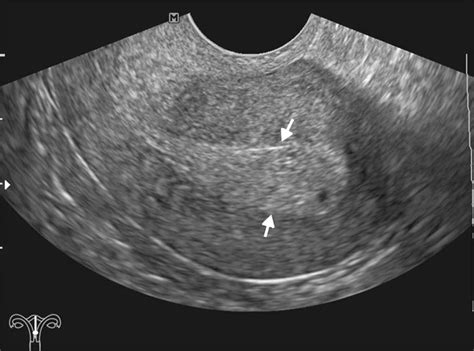 Ecografia endometrio per fertilità