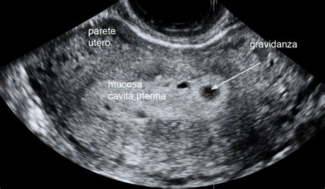 Ecografia embrione in utero