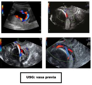 ecografia fetale con cordone ombelicale attorno al collo