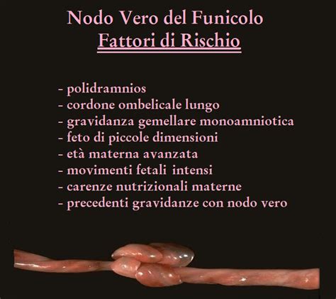 Illustrazione dettagliata della struttura del cordone ombelicale con un esempio di nodo vero e falso nodo
