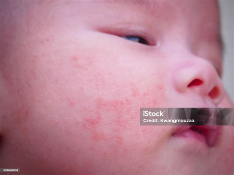 Neonato con eczema sul viso