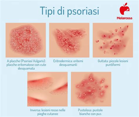 Psoriasi: placche eritematose con squame biancastre su gomito