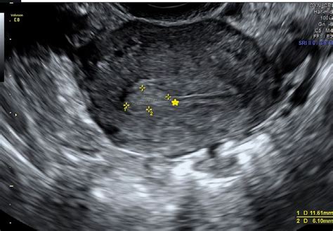 Vista ecografica dell'utero con endometrio