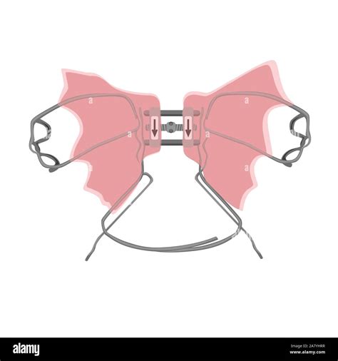 Illustrazione di un apparecchio ortodontico