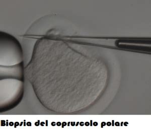Ovocita in seconda metafase con primo globulo polare
