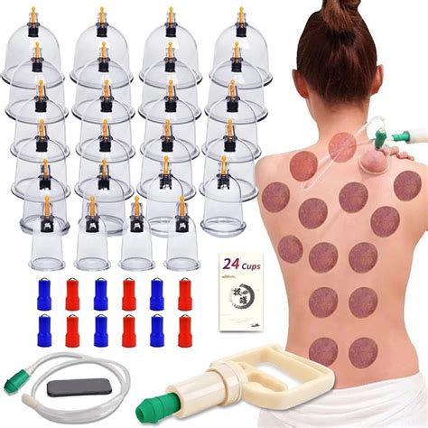 tecnica di cupping con ventose su una schiena