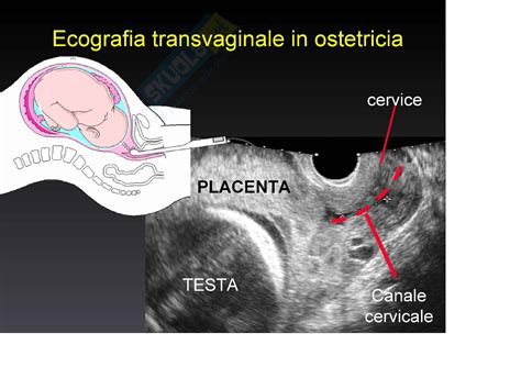 Immagine ecografica di placenta previa