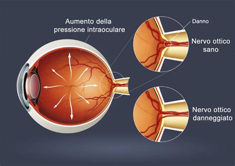 rappresentazione microscopica del nervo ottico e delle strutture cellulari oculari coinvolte nel processo degenerativo del glaucoma