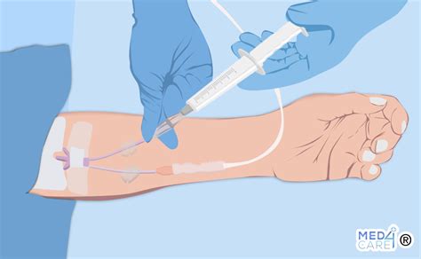 Infusione Endovenosa