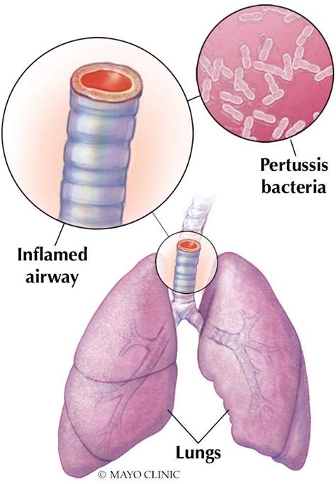 Pertussis bacteria or affected lungs diagram