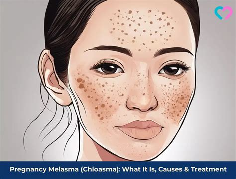 Melasma during pregnancy