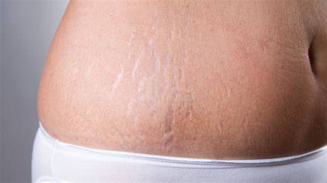Stretch marks on skin