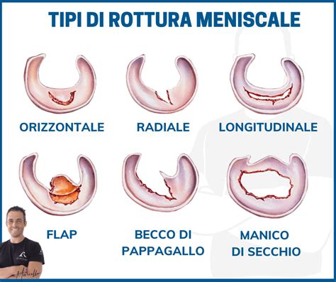 grafico che illustra le epoche gestazionali e il rischio di rottura delle membrane