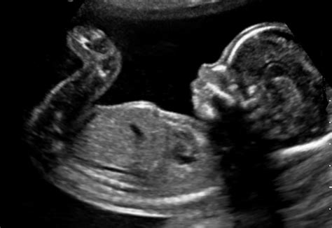 Ecografia fetale a 23 settimane