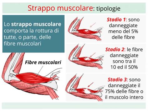 Diagramma che illustra i diversi gradi di strappo muscolare
