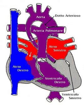 Cuore con Sindrome del Cuore Sinistro Ipoplasico