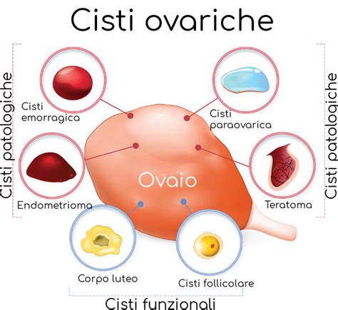 immagine stilizzata di un'ovaio con piccole cisti