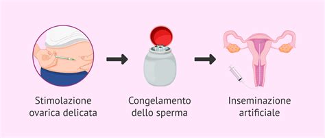 Fasi dell'inseminazione artificiale con donatore