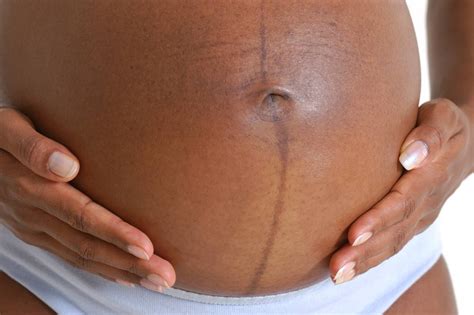 Cambiamenti della pelle in gravidanza: linea nigra e melasma