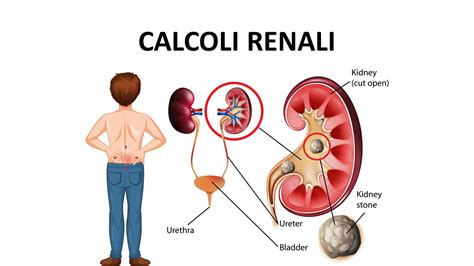 Diagramma di un rene con calcoli renali