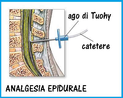 Rappresentazione schematica dell'anatomia epidurale e posizionamento del catetere per anestesia