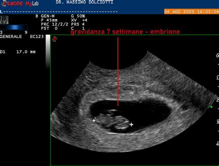 embrione di sette settimane