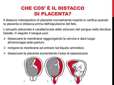 Illustrazione comparativa tra scollamento delle membrane e distacco di placenta