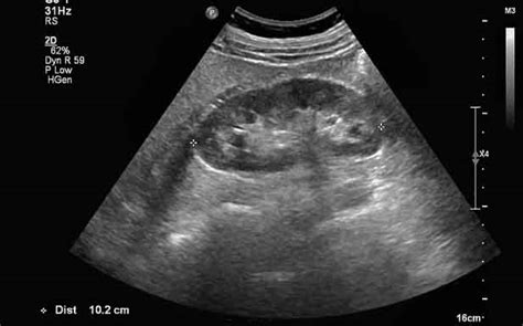 Immagine ecografica che mostra un calcolo renale