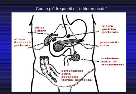 Infografica delle principali cause di addome acuto