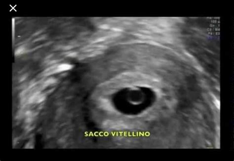 Sacco vitellino nelle prime settimane di gravidanza