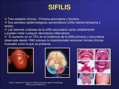 Sifiloma primario
