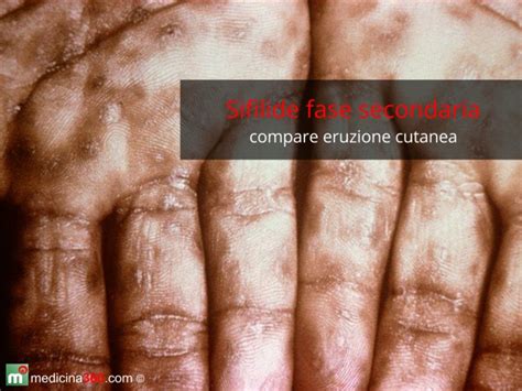 Eruzione cutanea della sifilide secondaria