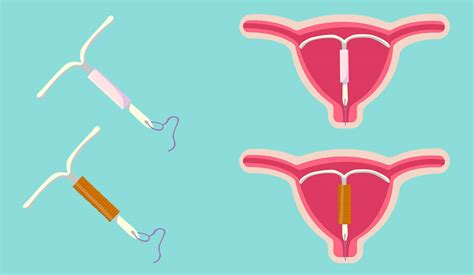 Illustrazione del posizionamento di una spirale intrauterina (IUD)