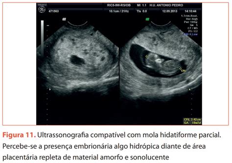 Mola idatiforme ecografia