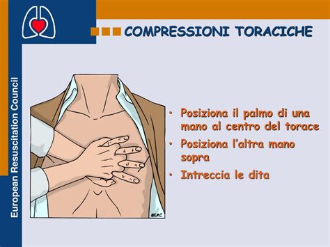 Illustrazione della tecnica corretta per le compressioni toraciche (chest thrusts) su un neonato