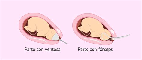 Illustrazione parto con ventosa