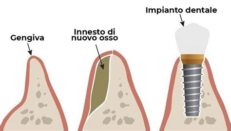 Innesto osseo